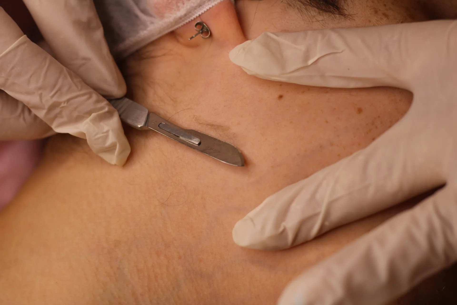 Dermaplaning