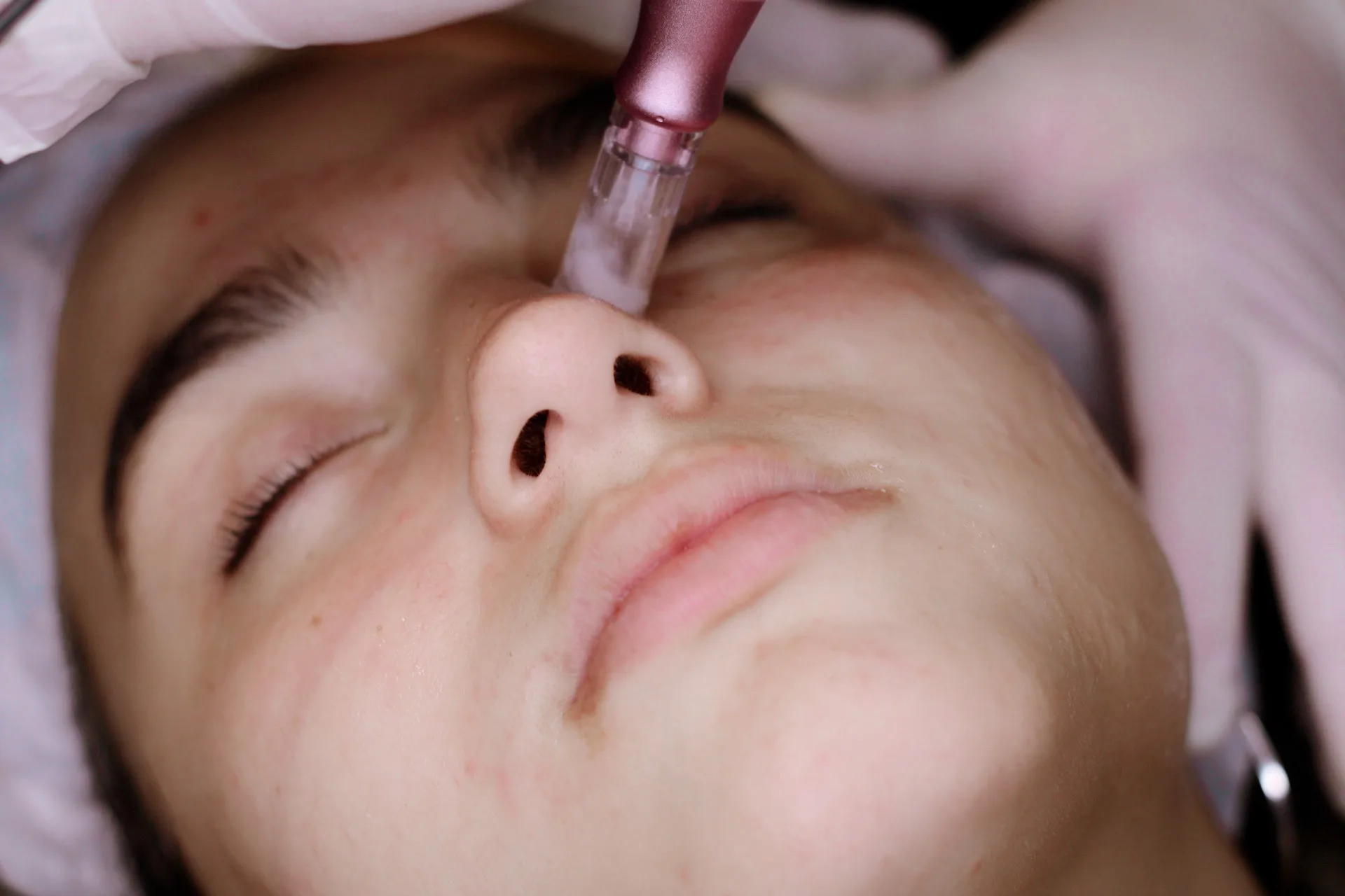 Dermapen